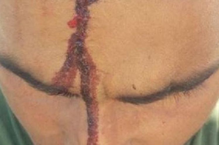 Λάππα αχαίας: Αλλοδαπός εργάτης χτυπήθηκε με αξίνα στο κεφάλι γιατί ζήτησε δεδουλευμένα